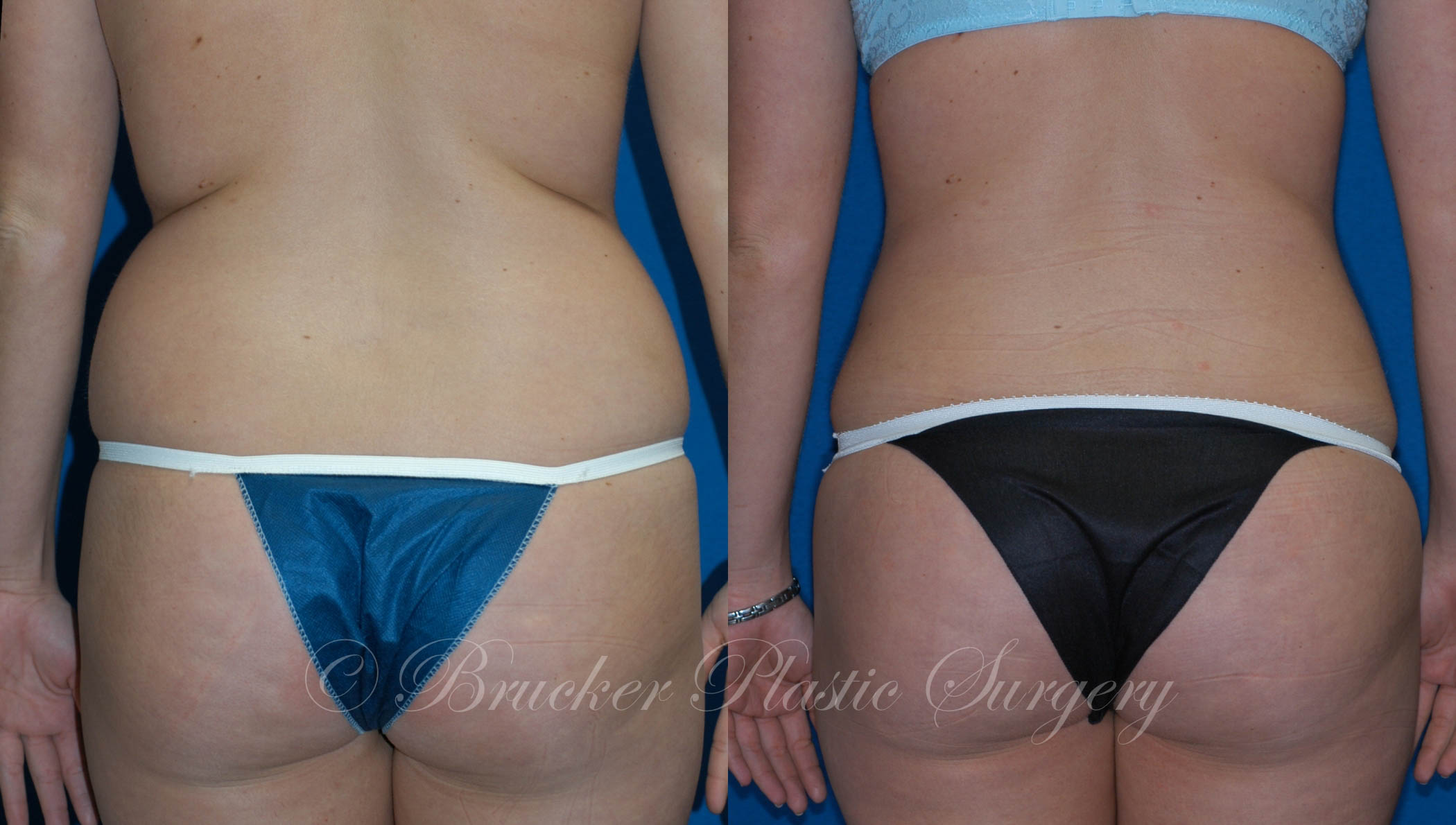 Patient 3b Liposuction Before and After