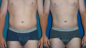 Patient 1a Liposuction Before and After