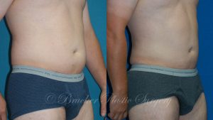 Patient 1b Liposuction Before and After