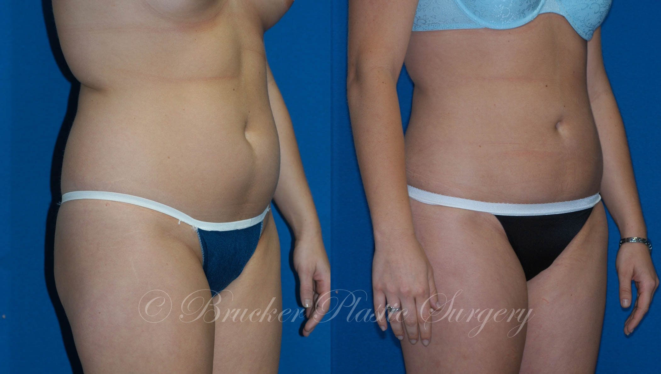 Patient 3c Liposuction Before and After