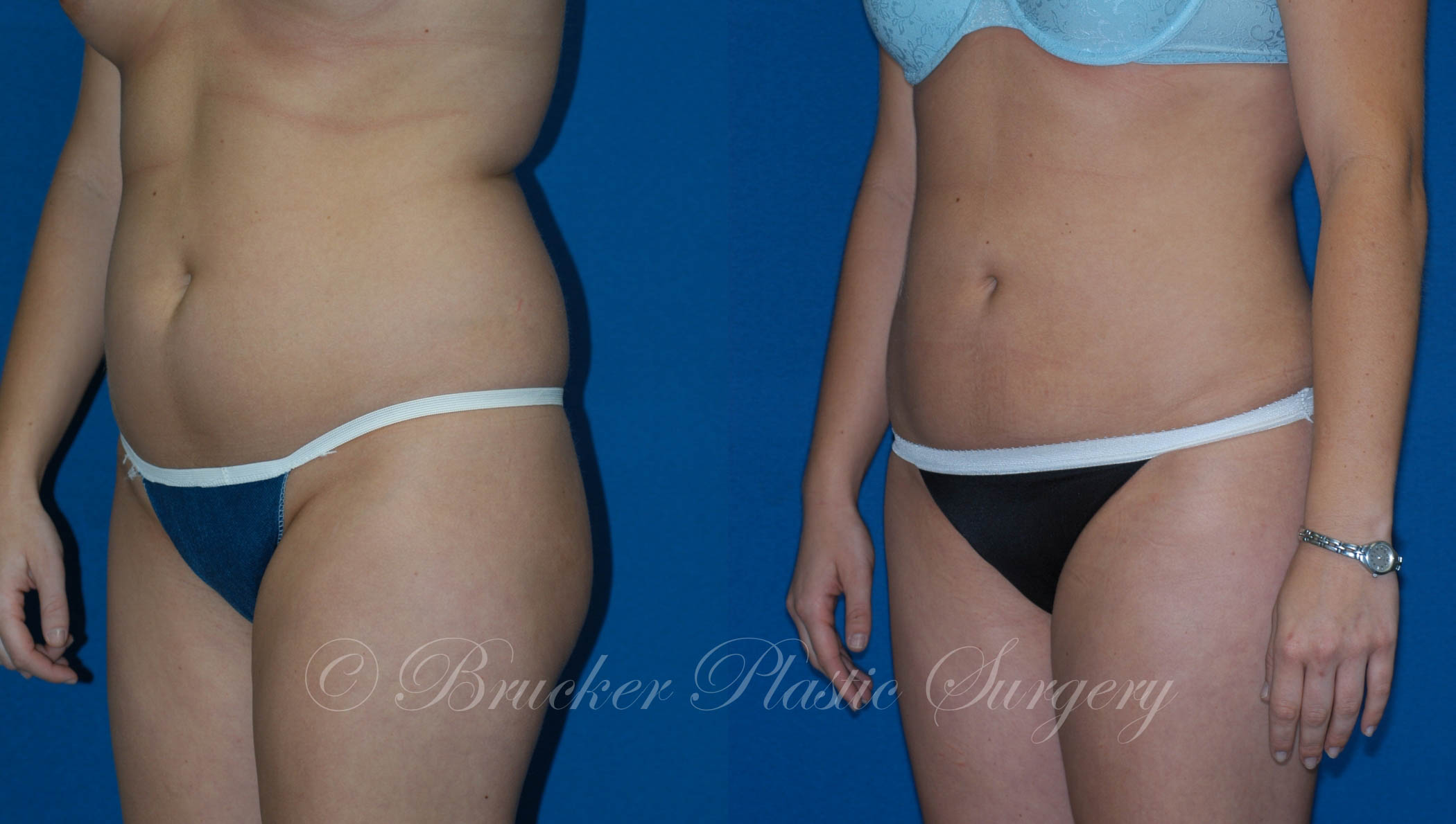 Patient 3d Liposuction Before and After
