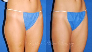 Patient 2b Liposuction Before and After