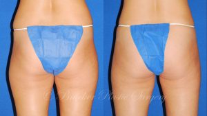 Patient 2c Liposuction Before and After