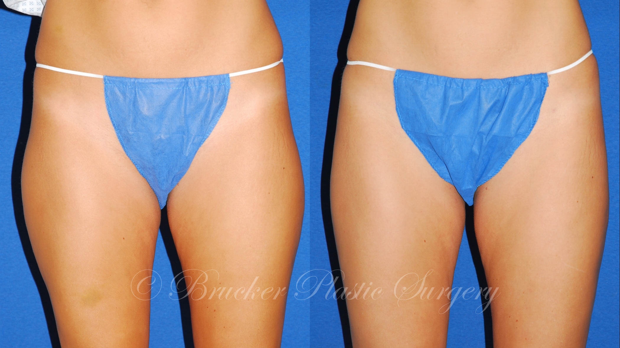Patient 2a Liposuction Before and After