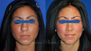 Patient 3a Rhinoplasty Before and After