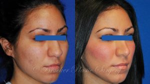 Patient 3b Rhinoplasty Before and After