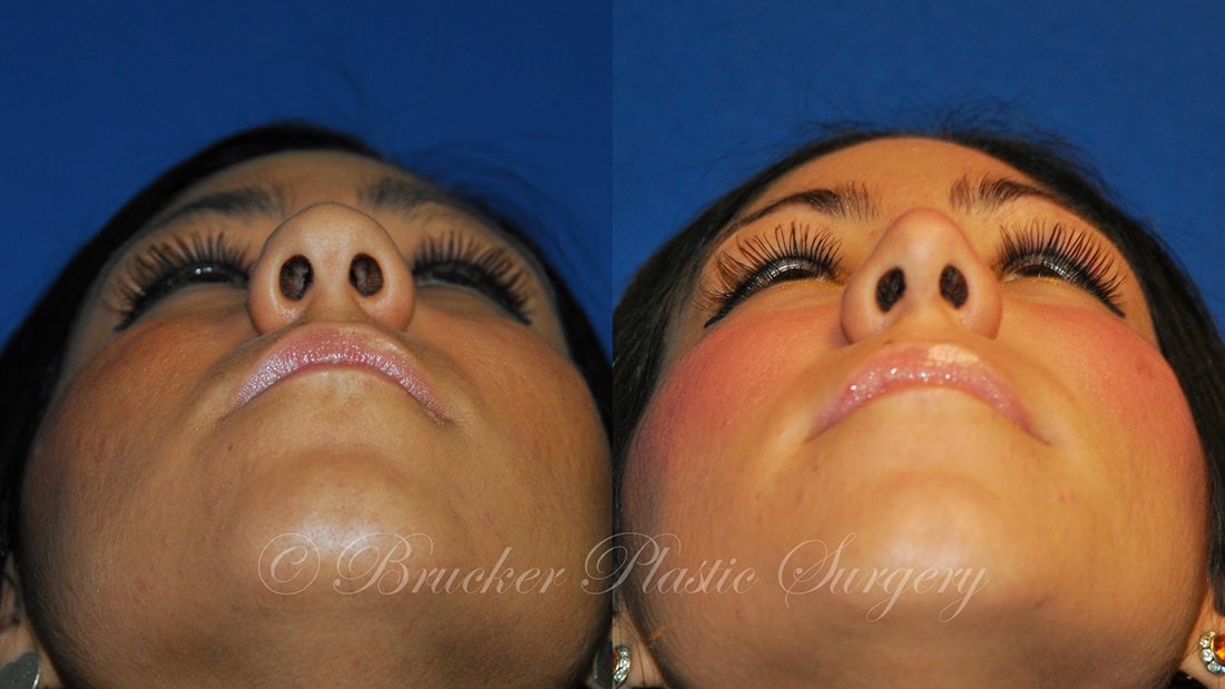 Patient 3c Rhinoplasty Before and After