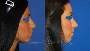 Patient 3d Rhinoplasty Before and After