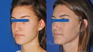 Patient 1a Rhinoplasty Before and After