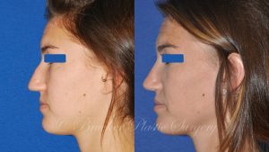 Patient 1b Rhinoplasty Before and After