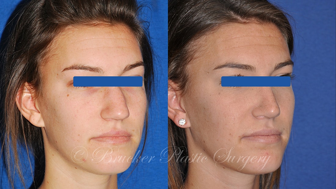 Patient 1c Rhinoplasty Before and After