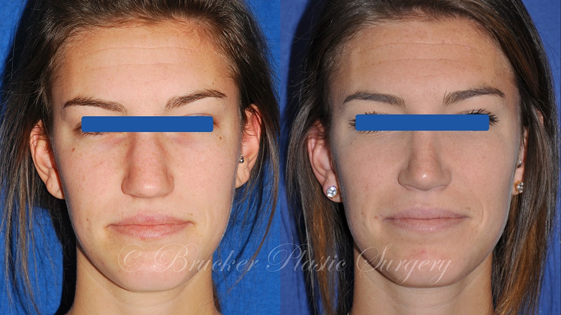 Patient 1d Rhinoplasty Before and After