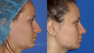 Patient 2b Rhinoplasty Before and After