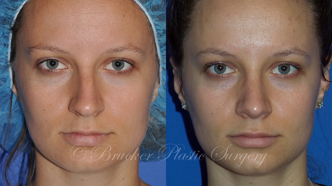 Patient 2c Rhinoplasty Before and After