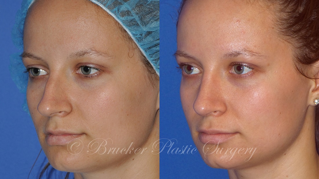Patient 2a Rhinoplasty Before and After