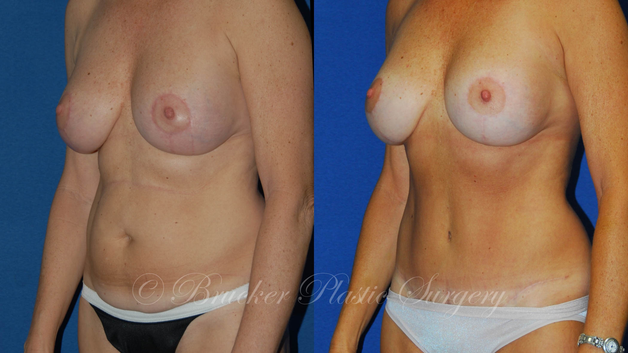 Patient 3b Tummy Tuck Before and After