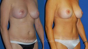 Patient 3a Tummy Tuck Before and After