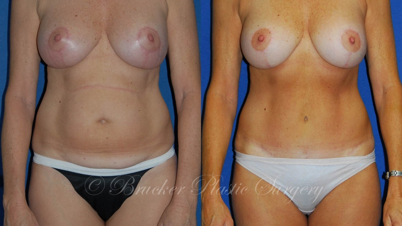 Patient 3c Tummy Tuck Before and After
