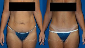 Patient 1a Tummy Tuck Before and After