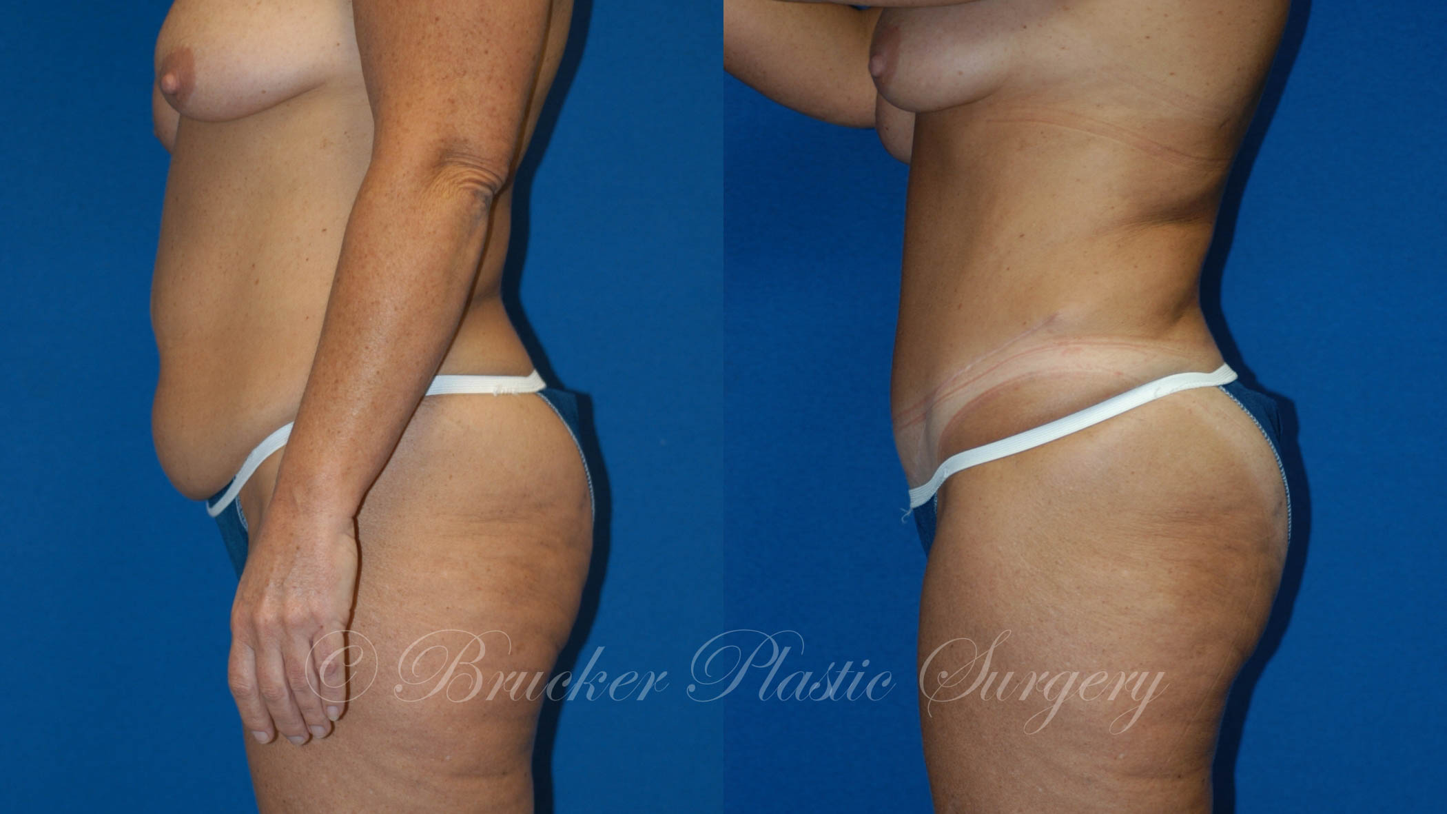 Patient 1b Tummy Tuck Before and After
