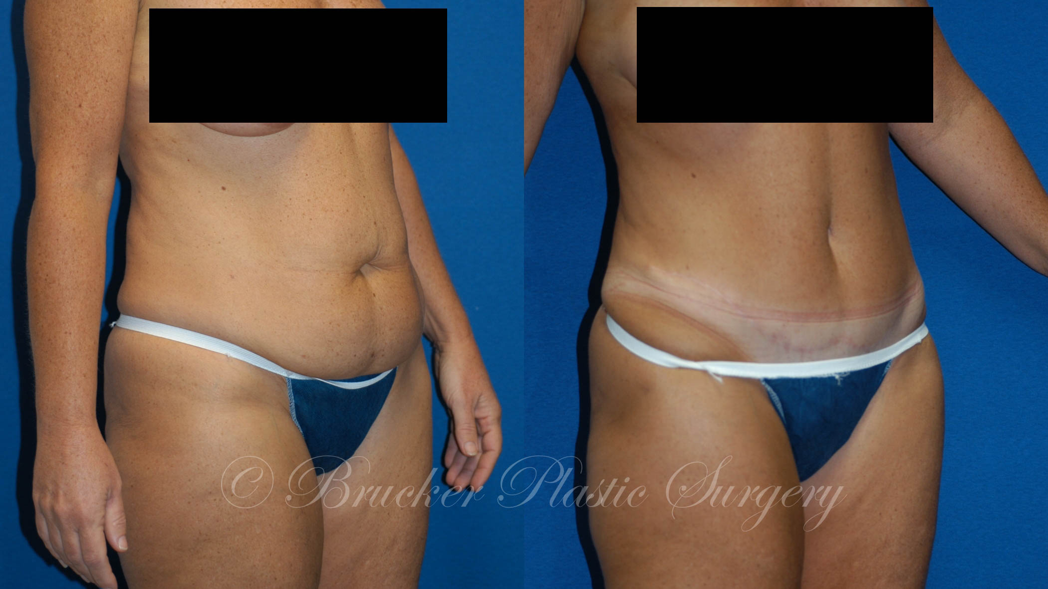 Patient 1c Tummy Tuck Before and After