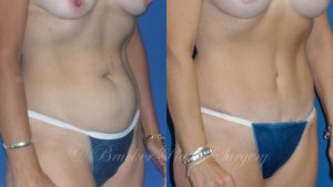 Patient 2b Tummy Tuck Before and After