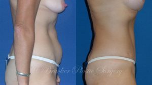 Patient 2c Tummy Tuck Before and After