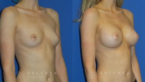 Patient 7a Breast Augmentation Before and After