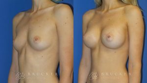 Patient 7b Breast Augmentation Before and After