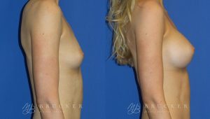 Patient 7c Breast Augmentation Before and After