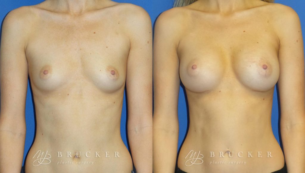 Patient 7d Breast Augmentation Before and After