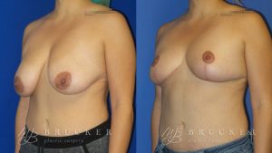 Patient 4b Breast Reduction Before and After