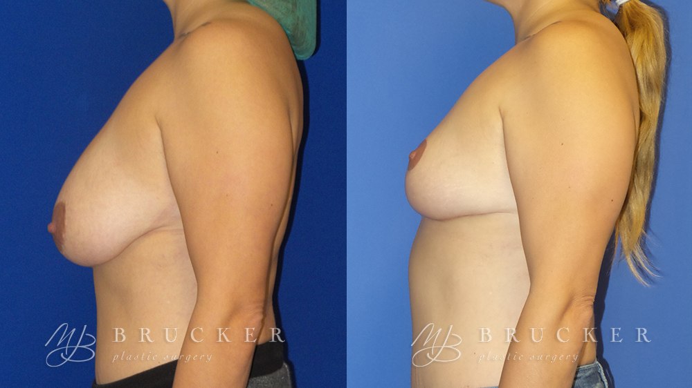 Patient 4c Breast Reduction Before and After