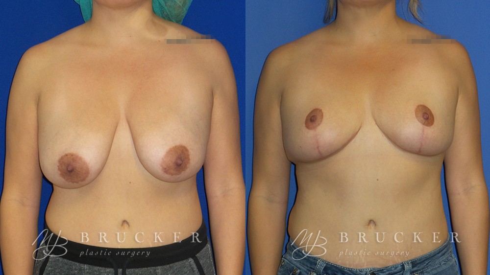 Patient 4a Breast Reduction Before and After