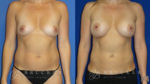 Patient 8a Breast Augmentation Before and After