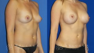 Patient 8b Breast Augmentation Before and After