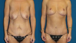 DrBrucker_LaJolla_Breast_Lift_B&A_Patient2_Front