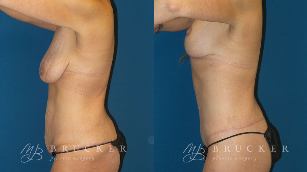 DrBrucker_LaJolla_Breast_Lift_B&A_Patient2_Side Arms Up (Left)