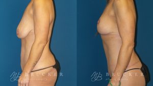 DrBrucker_LaJolla_Breast_Lift_B&A_Patient2_Side(Left)