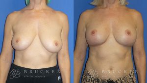 Patient 1a Breast Lift Before and After