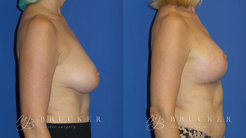 Patient 1c Breast Lift Before and After