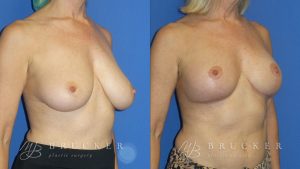 Patient 1b Breast Lift Before and After