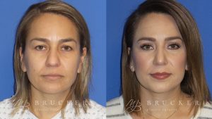 Blepharoplasty Before and After Photo - Patient 1 Front View