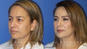 Blepharoplasty Before and After Photo - Patient 1 Oblique View