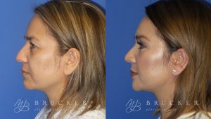 Blepharoplasty Before and After Photo - Patient 1 Side View