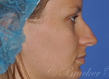 Rhinoplasty-La-Jolla-Patient-2.1